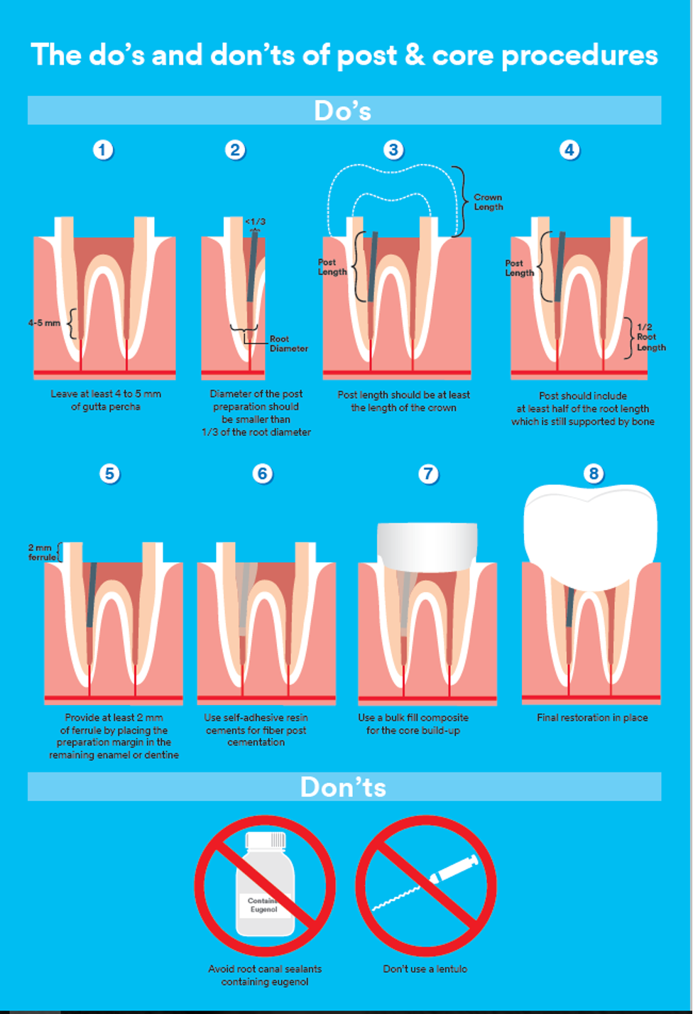 The do's and don'ts of post & core procedures