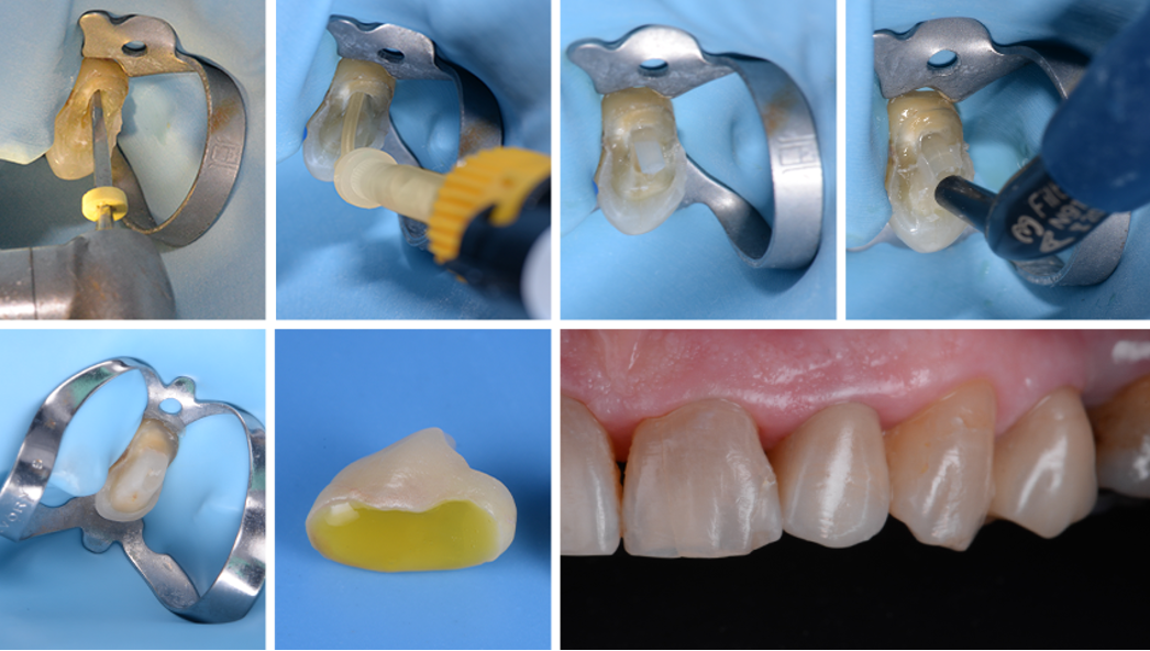 The do's and don'ts of post & core procedures