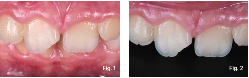 30-Piece Dental Veneers Mould – Composite Resin Anterior Teeth For Light Cure Restoration