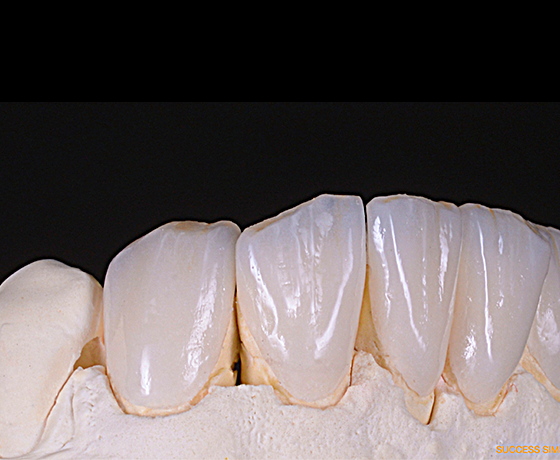 Feldspathic glass ceramic veneers on model