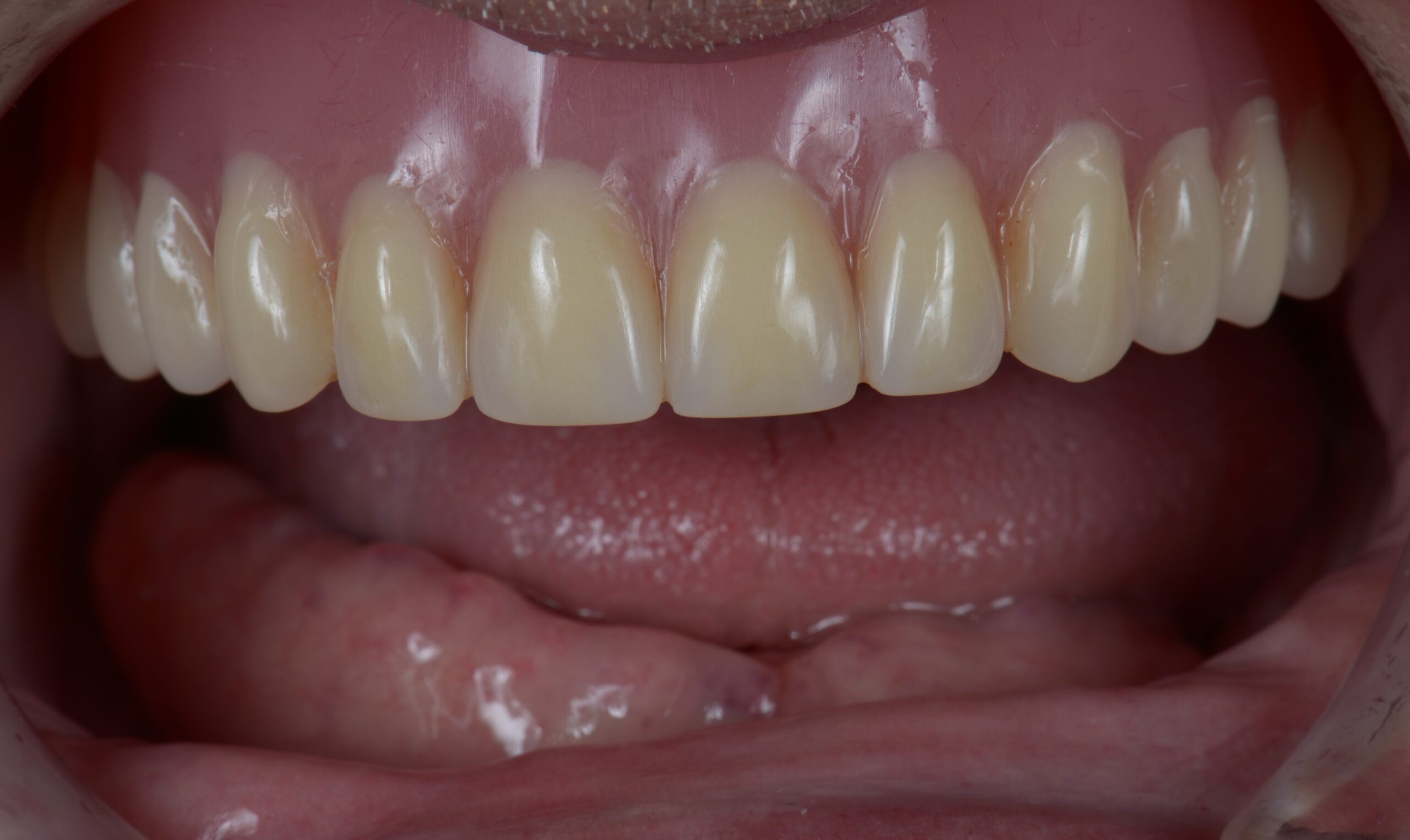 Close-up of a person's mouth showing upper dentures and missing lower teeth.