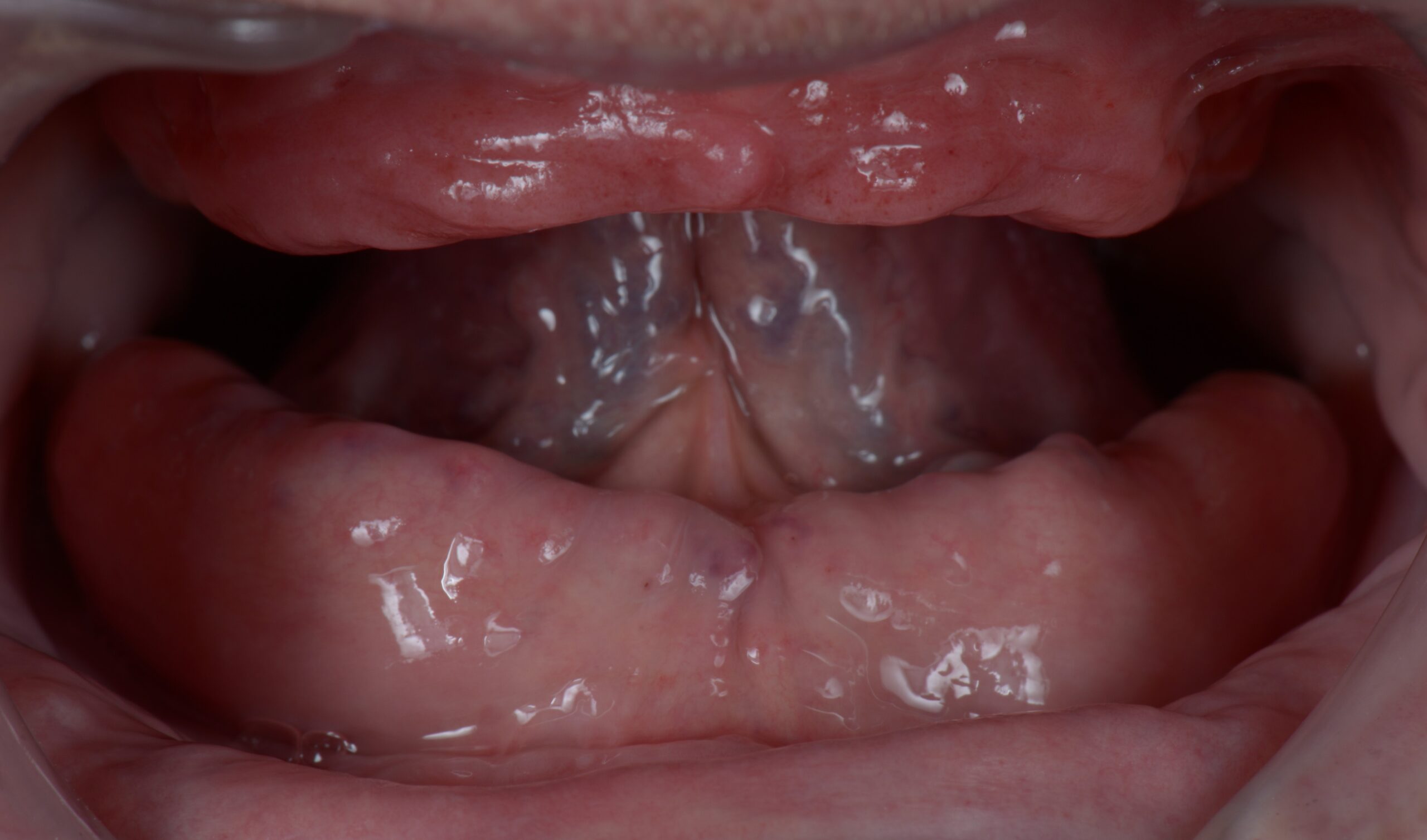 Close-up view of the inside of a person's mouth, showing the lower gums, tongue, and oral tissues with visible saliva.