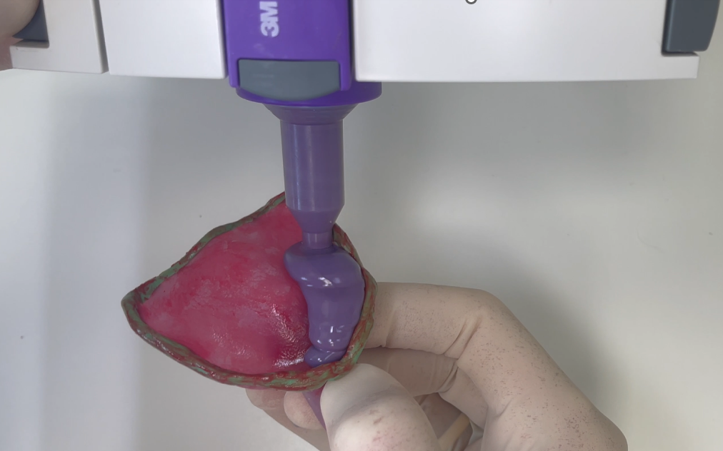 A gloved hand holds a dental impression tray while a purple dispenser applies dental material onto the tray.