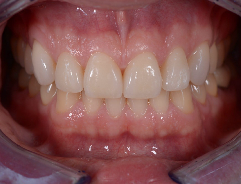 Teeth close-up of upper and lower jaw showing the new upper jaw with attached veneers