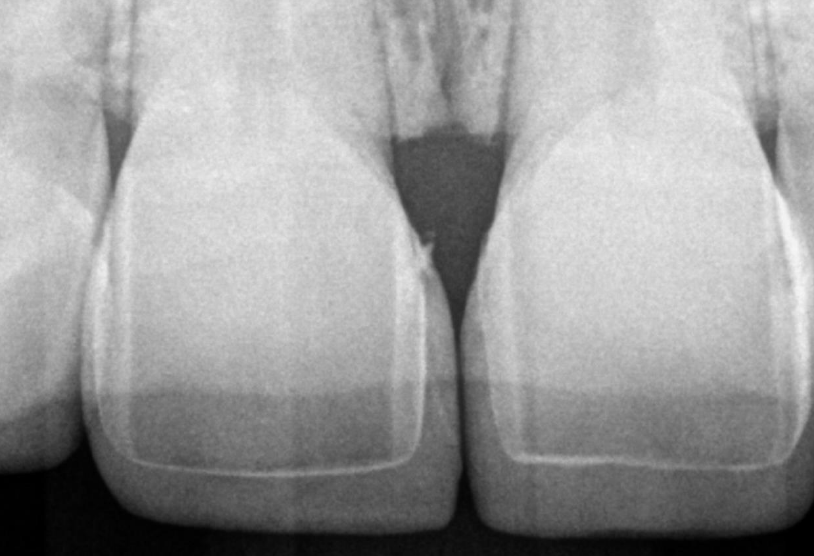 An x-ray image showing the teeth with the veneers attached
