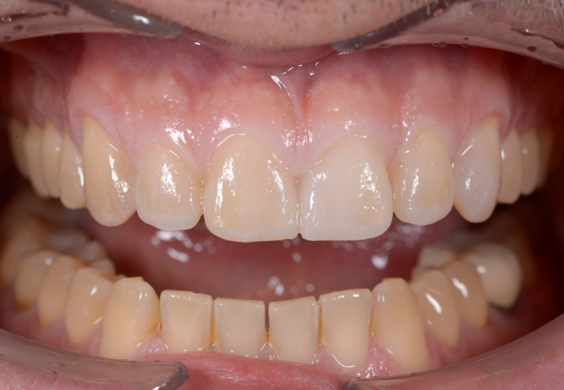 Close-up of teeth with the mouth slighty open