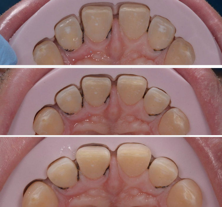 3 teeth close-ups combined in one image. Showing the upper jaw from underneith and pink paste