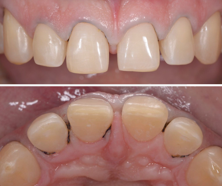 Teeth close-up from underneith and the front