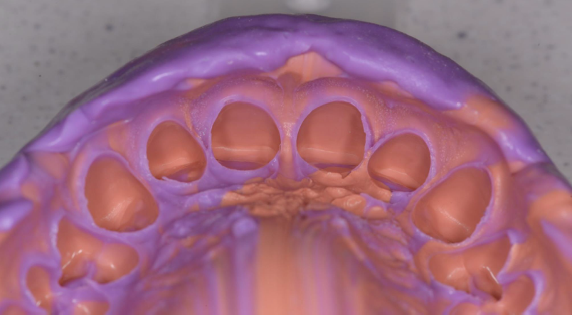 A teeth model, an impression of the patients teeth