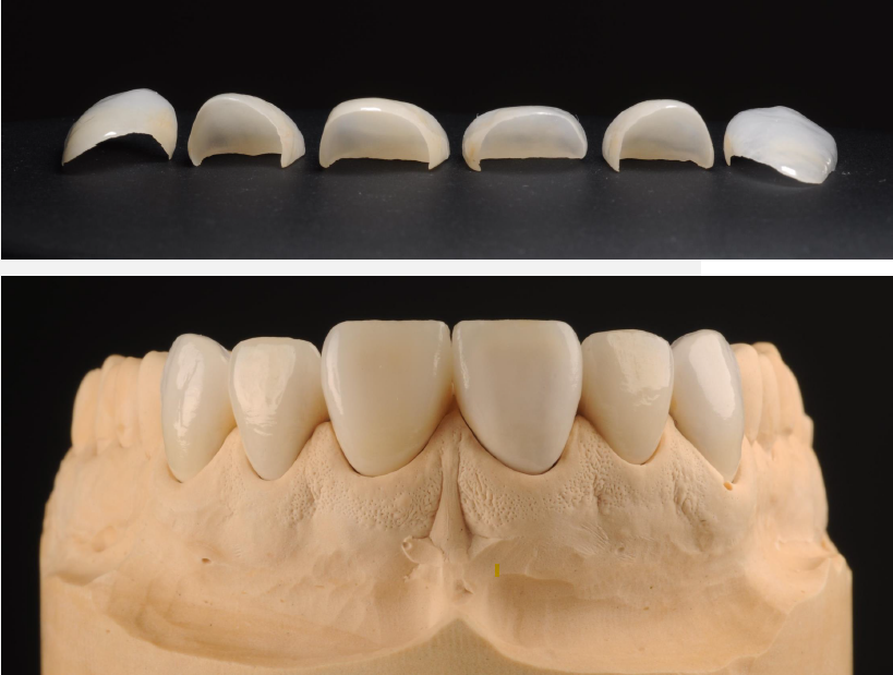 Front and underneith image of glass-ceramic veneers.