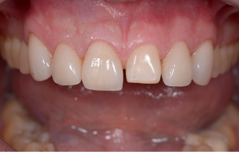 Close-up of the upper jaw with trying on the veneers