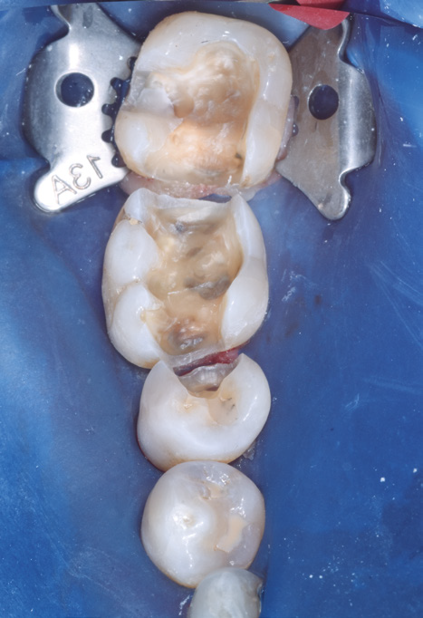 Occlusal view of posterior teeth isolated with a rubber dam and metal clamp, showing prepared cavities with exposed dentin and remaining enamel margins prior to restoration.