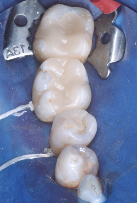 Occlusal view of the same posterior teeth after restoration, with smooth, tooth-colored composite fillings contoured to restore natural anatomy under rubber dam isolation.