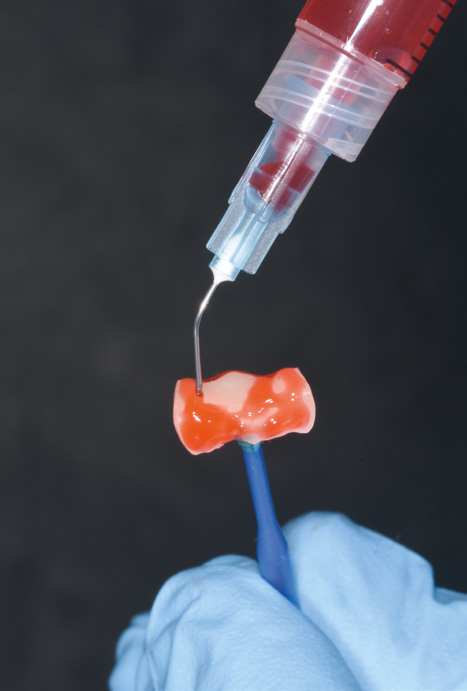 Close-up of a dental syringe dispensing flowable composite resin onto a small restoration surface held with an instrument, illustrating controlled placement of restorative material.