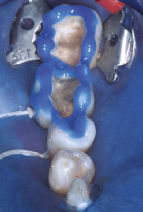 Close-up of a dental procedure showing a molar with blue dental material applied, surrounded by a rubber dam and metal clamp. The focus is on tooth restoration.