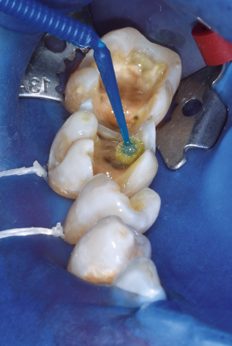 Close-up ten same dental procedure showing a decayed tooth being treated. A dental tool applies medication to the cavity, surrounded by a blue dental dam.