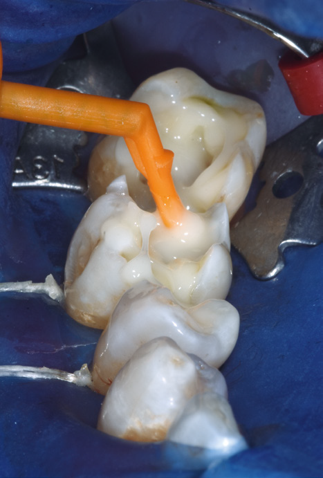 Close-up of dental procedure on molars, with a rubber dam isolating teeth. An orange tube applies a liquid. Metal clamps and blue background visible.