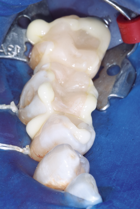 Close-up of dental impressions on a mold with white dental material filling cavities. The image includes a blue background and metal brackets.