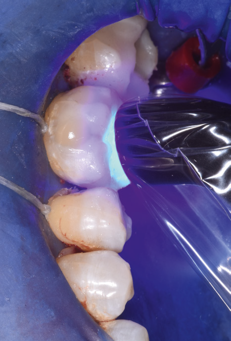 Close-up of dental procedure showing a curing light hardening resin on teeth, surrounded by a blue dental dam. The setting appears clinical and focused.