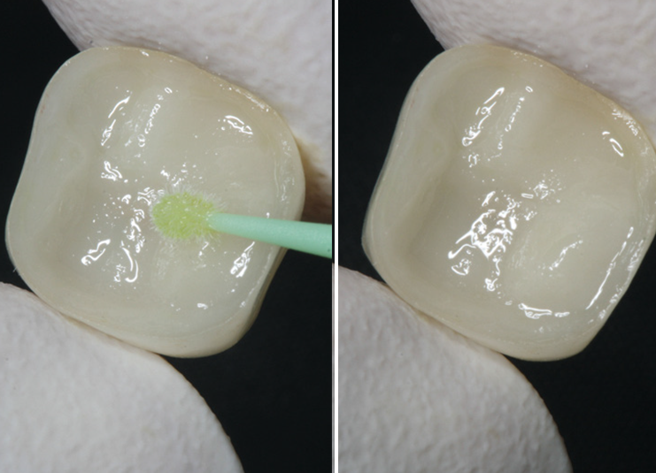 Close-up of two dental veneers. The left image shows a green applicator brushing one veneer, while the right shows the same veneer without the applicator.
