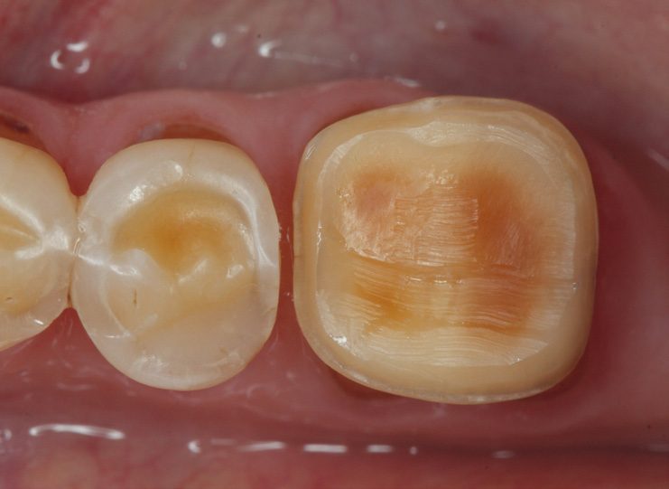 Close-up of two human teeth; the right tooth shows significant enamel wear and yellowish-brown discoloration, exposing underlying layers, while the left tooth appears mostly intact.