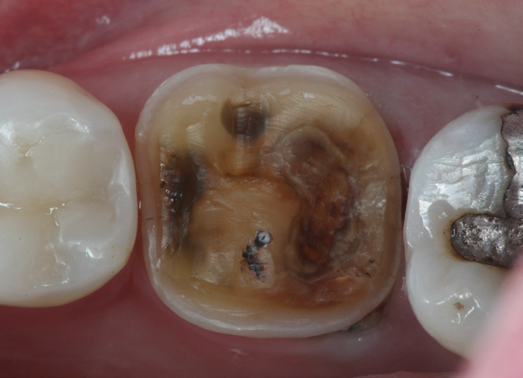 A close-up of three molars; the center tooth shows extensive dental decay and cavities, while the teeth on either side appear intact, one with a metal filling.