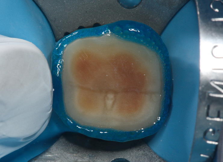 Close-up of a single tooth with blue dental etching gel applied to the enamel surface, prepared for a dental procedure.
