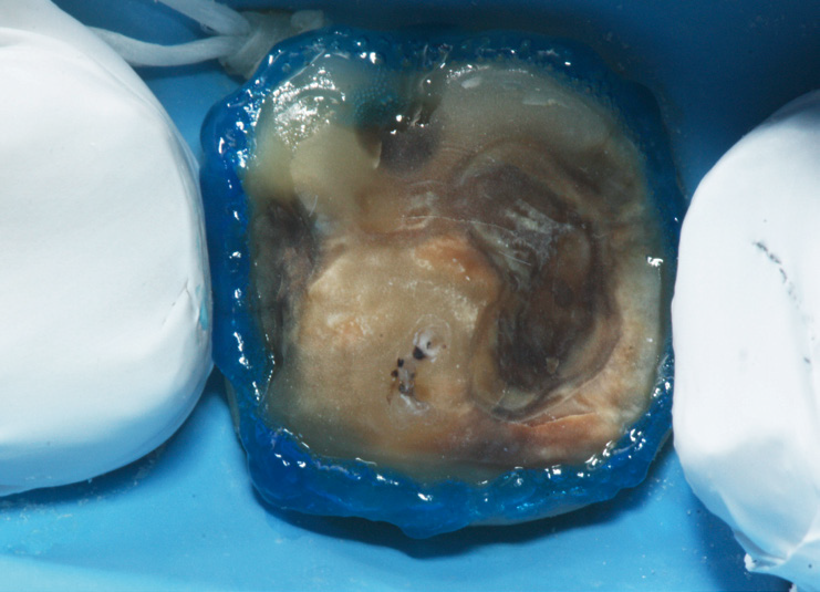 A close-up of a decayed tooth, isolated with blue dental dam material, showing significant discoloration and cavity damage.