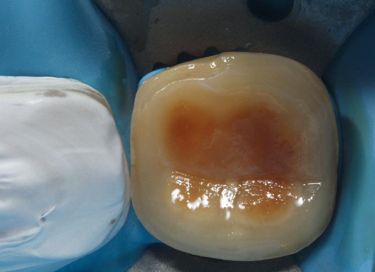 Close-up of a human tooth with visible brownish decay or staining on the surface, surrounded by dental dam material for isolation.