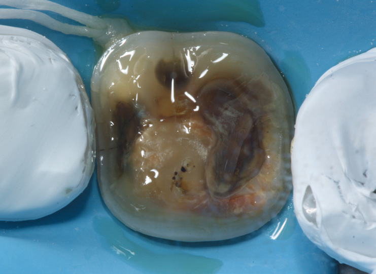 Close-up of a decayed tooth with visible brown and black areas, isolated with a dental dam for treatment; adjacent teeth are covered with dental material.