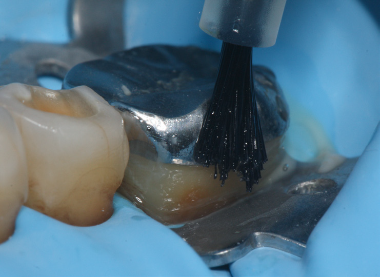 Close-up of a dental procedure with a brush applying liquid to a tooth covered by a metal dental clamp and surrounded by a blue dental dam