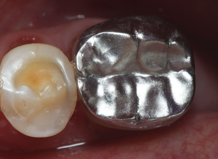 Close-up of two molars in a mouth, one with a metal dental crown and the other natural with a cavity
