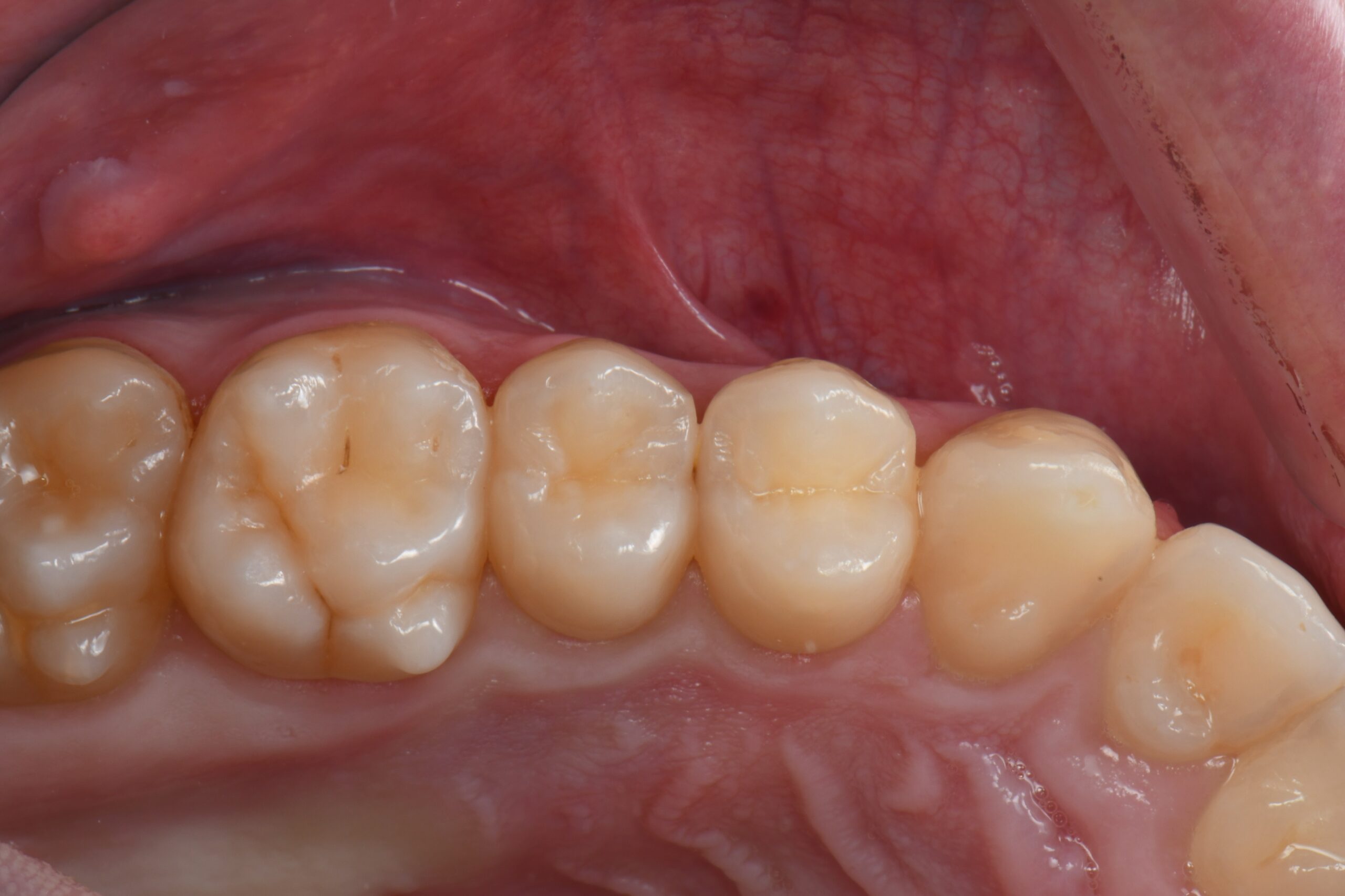 Lower row of molars and premolars with visible gums and inner cheek.