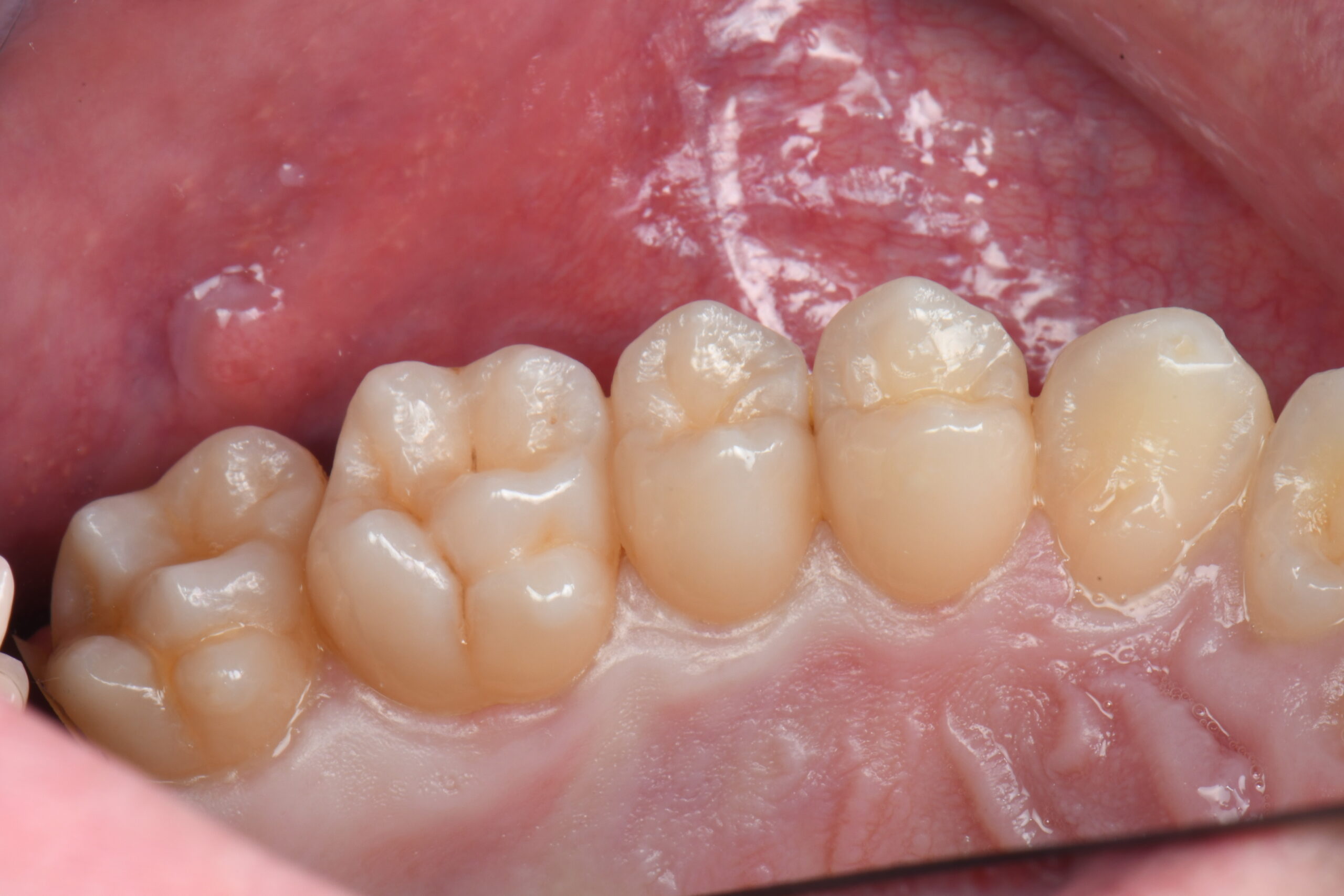 Close-up of four lower molars with visible grooves and cusps inside the mouth