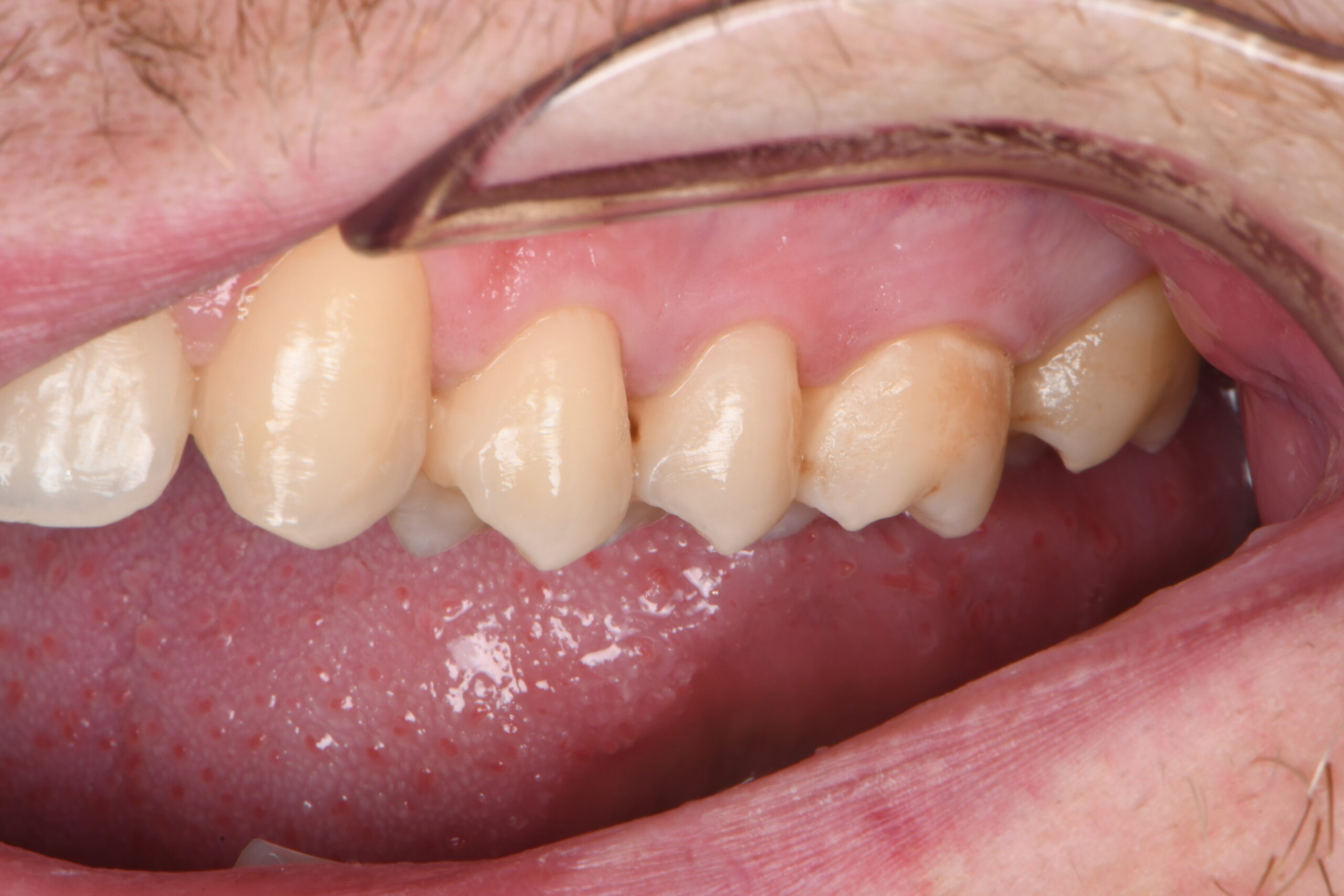 Close-up of lower molars and premolars with visible dental plaque and discoloration on some teeth