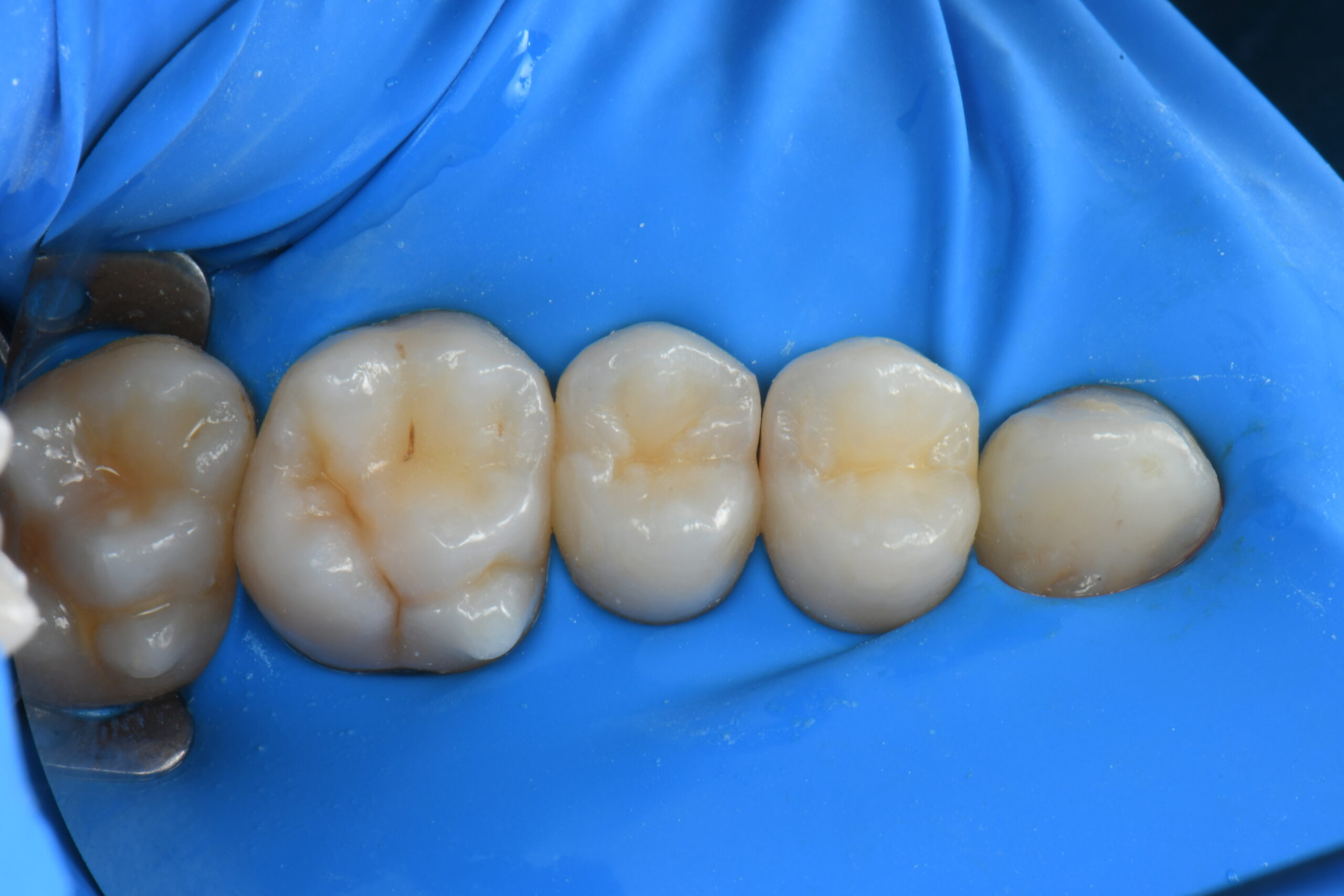 Five molar teeth isolated with a blue dental dam