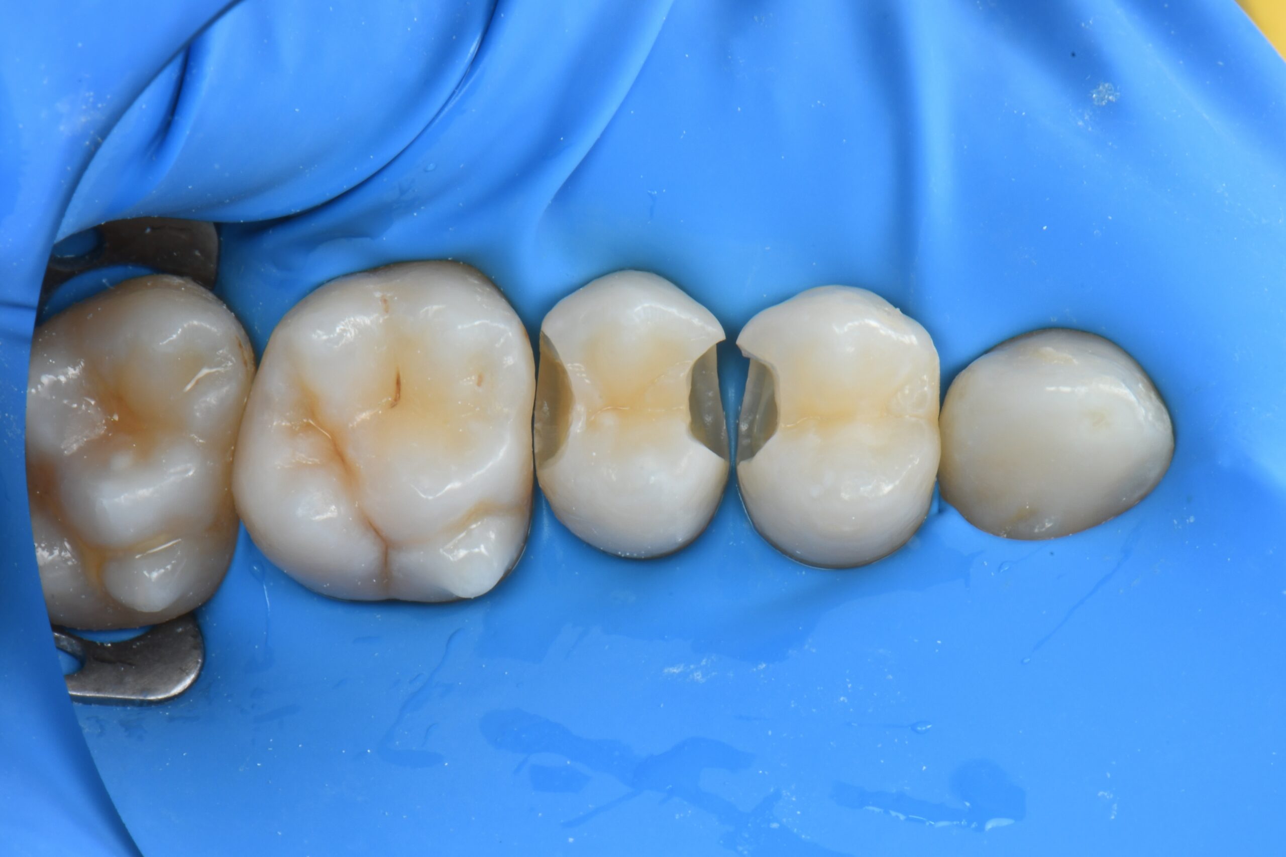 Close-up of four molar teeth isolated with a blue dental dam, two teeth have cavities prepared for fillings