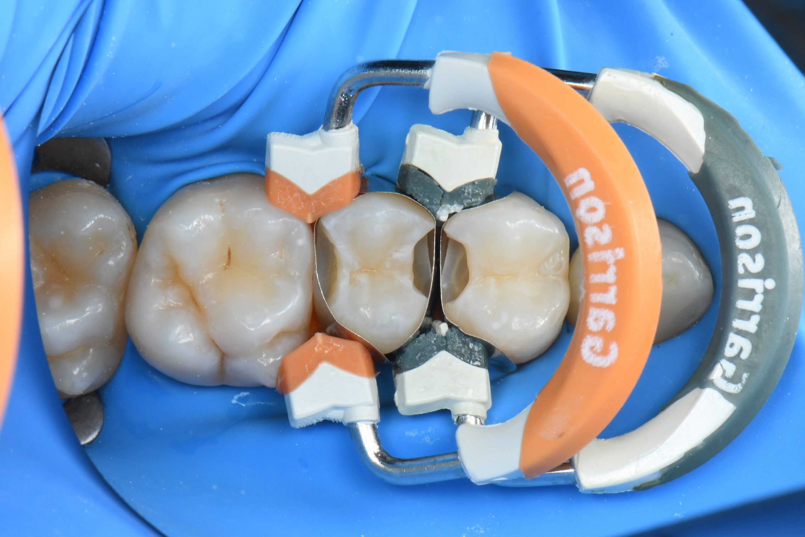 Close-up of molar teeth with dental matrix bands and wedges in place for restorative treatment
