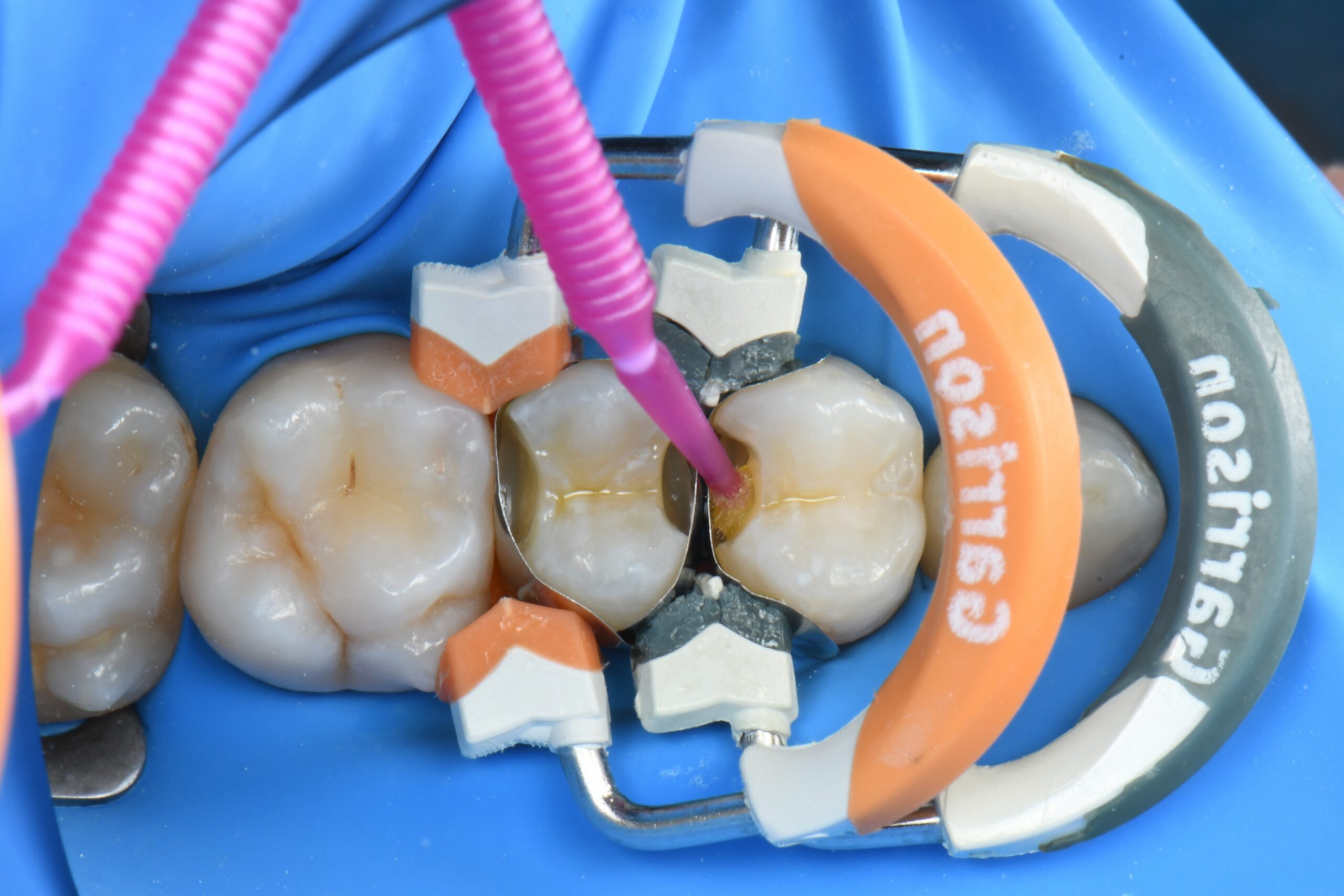 Close-up of dental procedure with rubber dam and metal matrix bands around molars and a dental instrument applying material between teeth