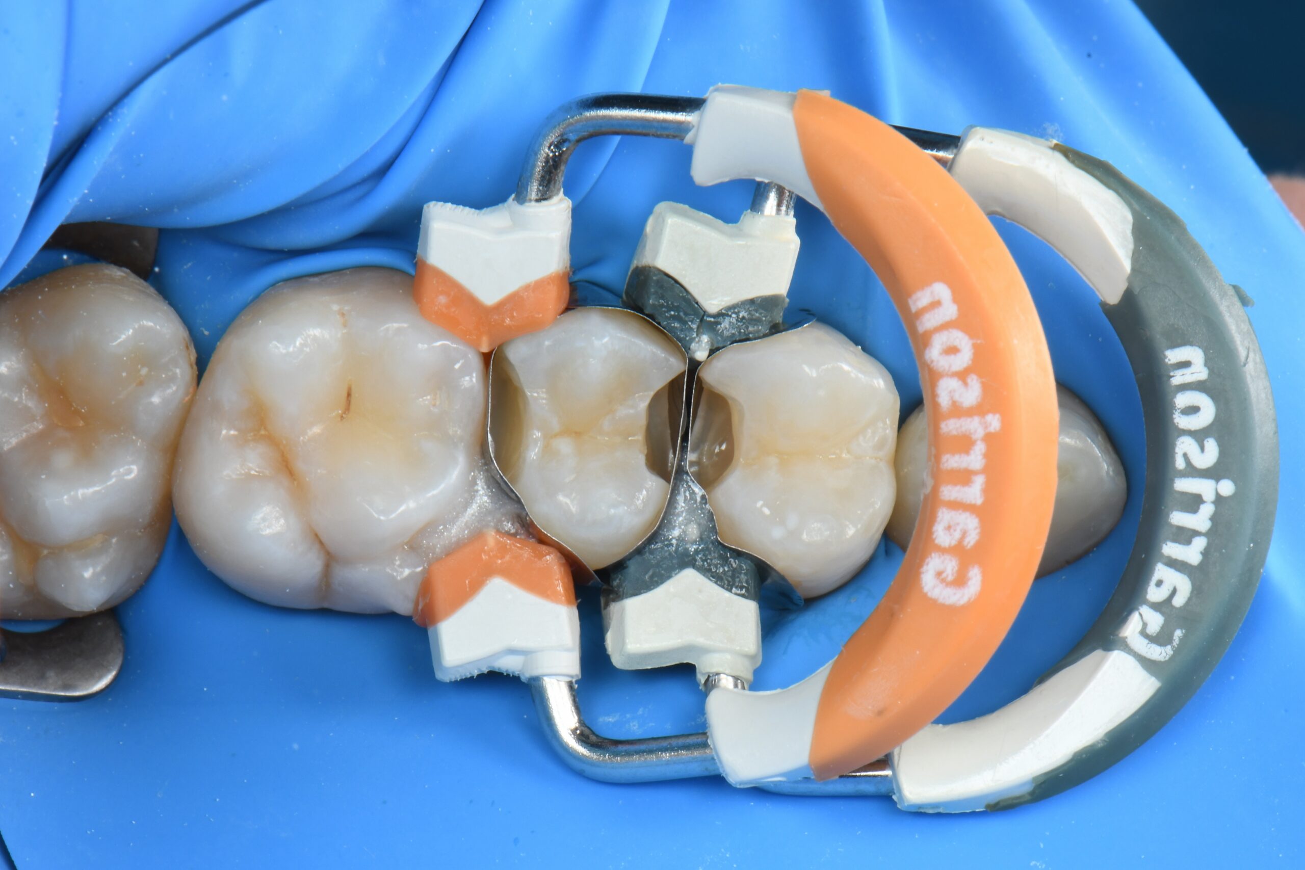 Close-up of molar teeth with dental matrix bands and a rubber dam clamp in place