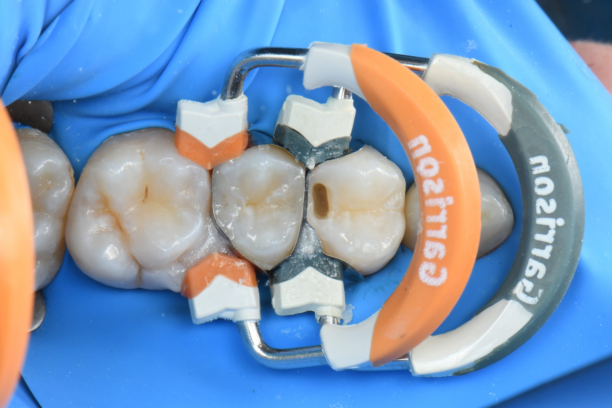 Close-up of molar teeth with dental matrix bands and a rubber dam clamp in place