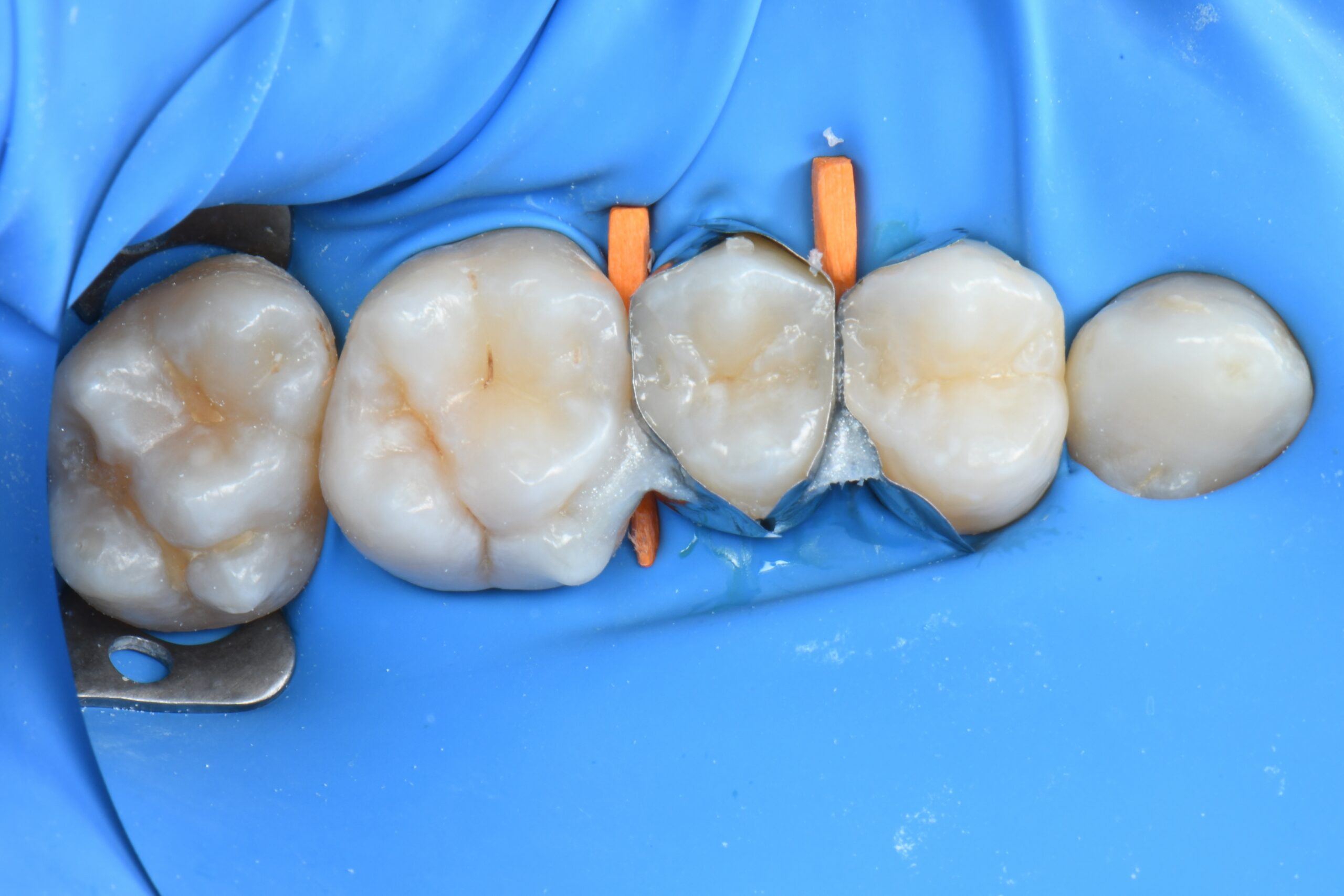 Close-up of four molar teeth isolated with a blue dental dam and separated by orange wedges