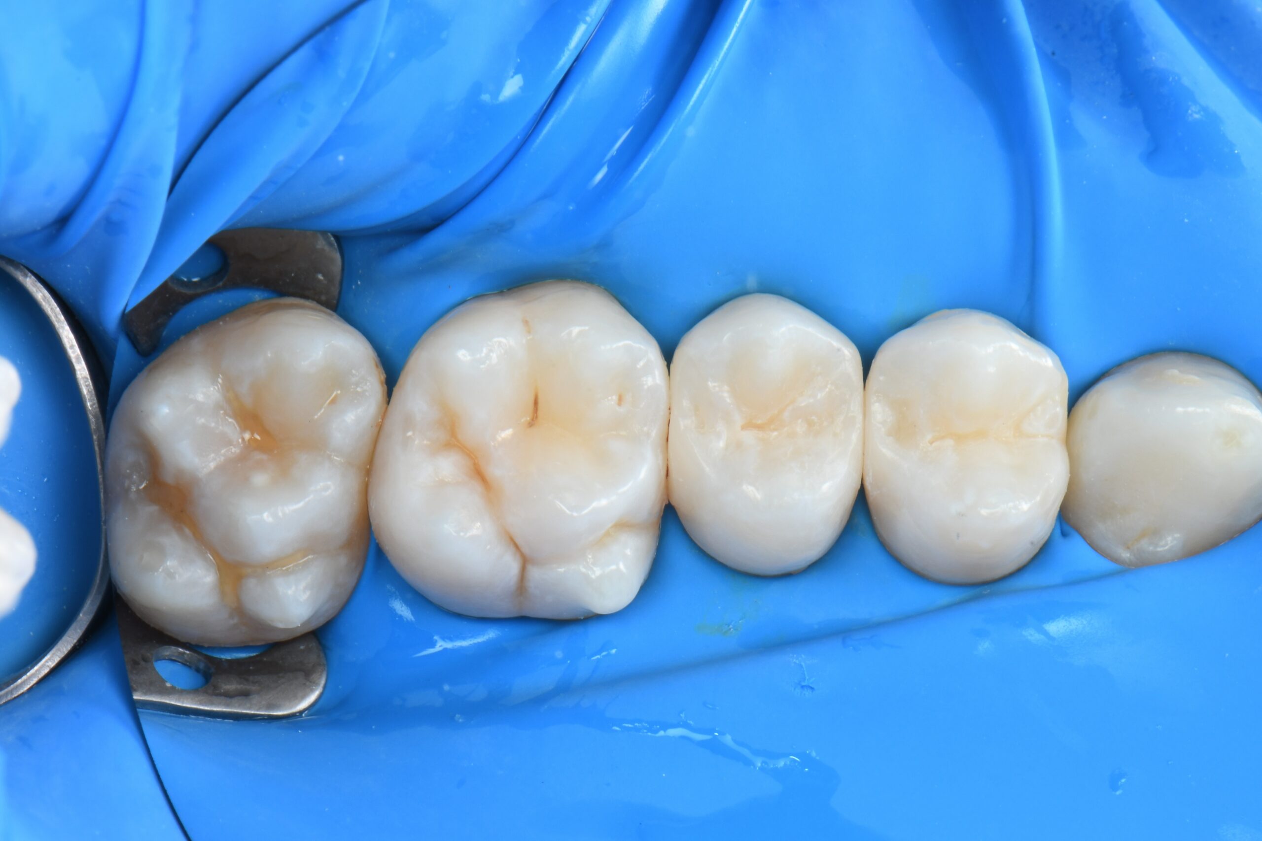 Close-up of four molar teeth isolated with a blue dental dam and metal clamp on the leftmost tooth
