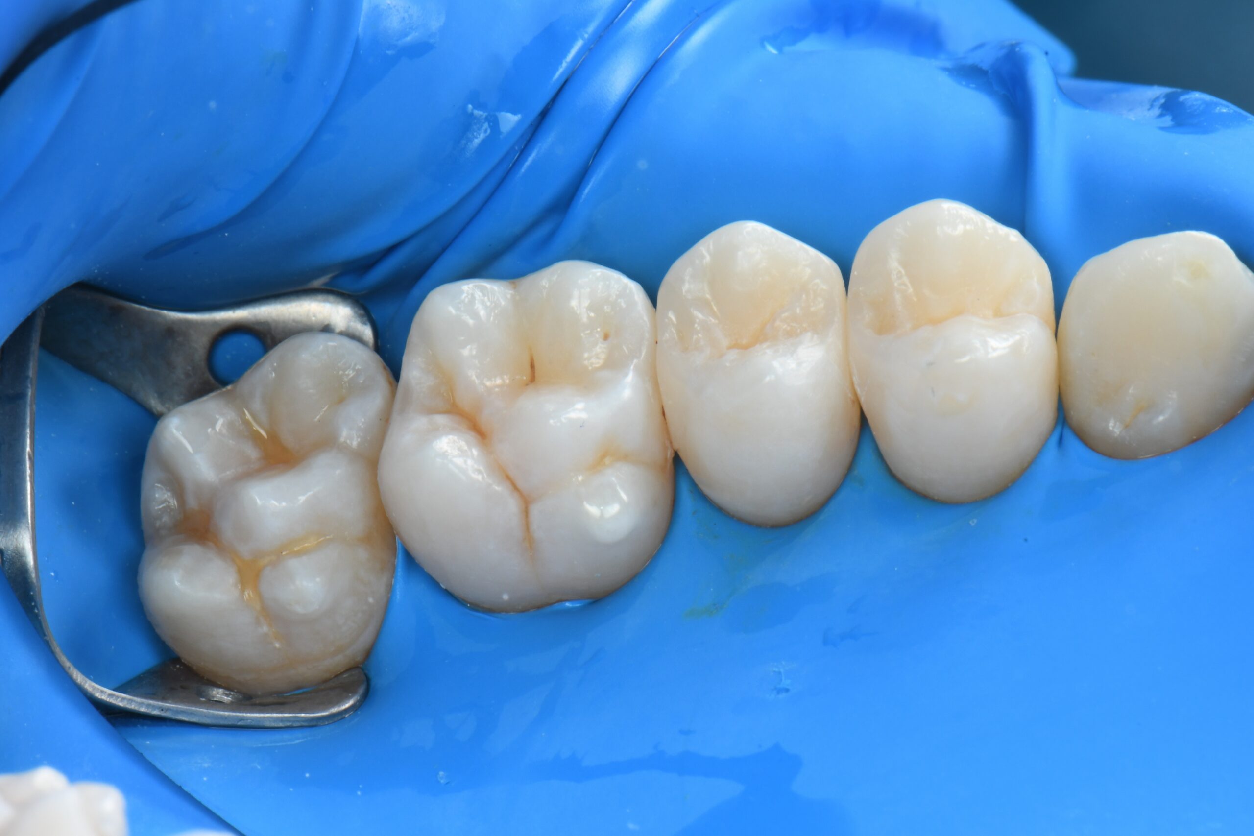 Close-up of molars with dental dam and metal clamp on one tooth