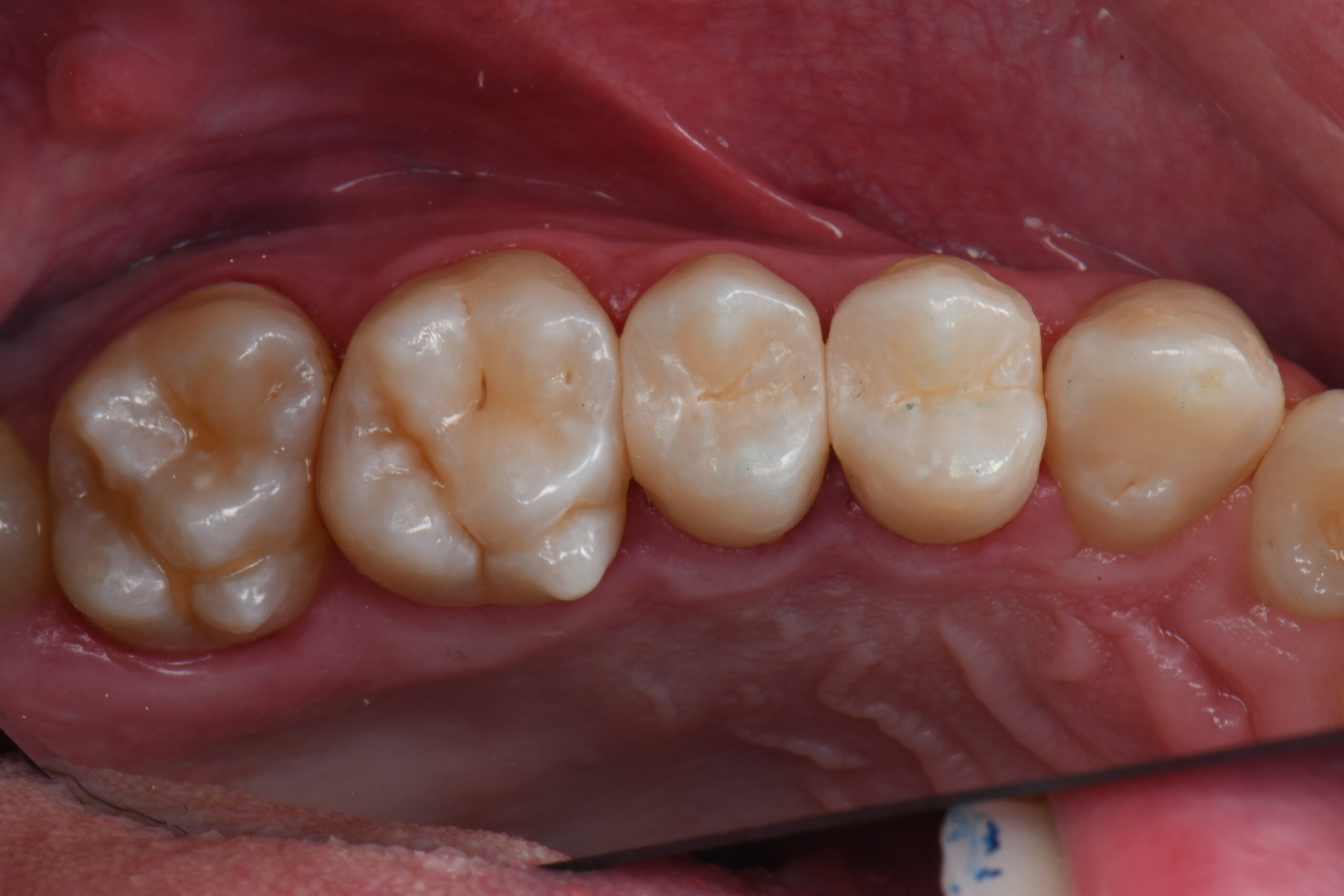Close-up of six lower molars and premolars with visible occlusal surfaces and surrounding gum tissue