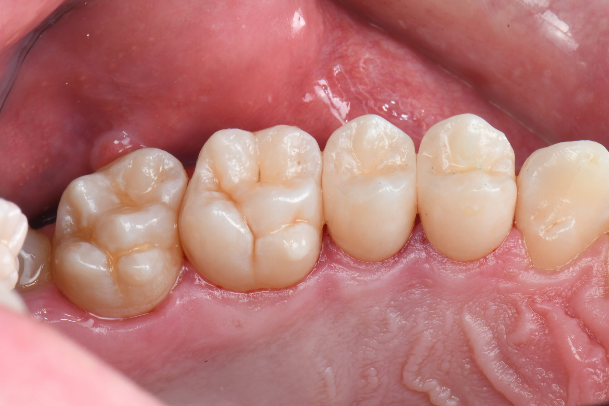 Close-up of four lower molars with visible grooves and cusps on the chewing surfaces