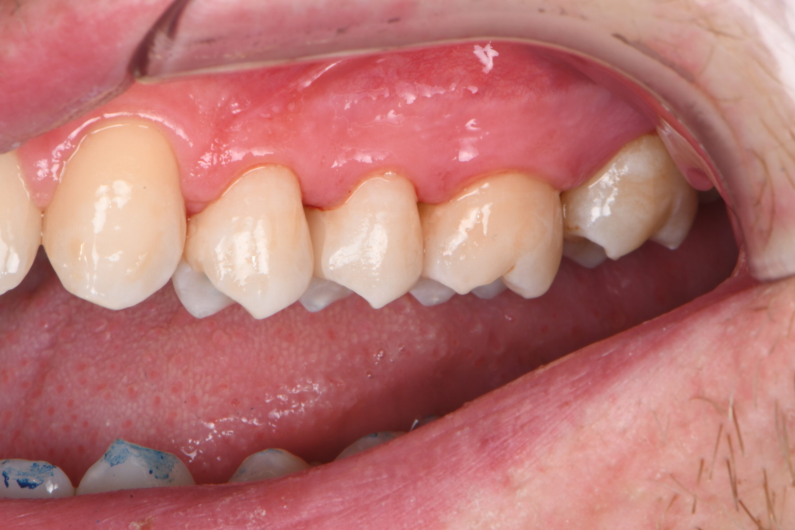 Close-up of upper teeth showing dental crowns and natural teeth with visible gums
