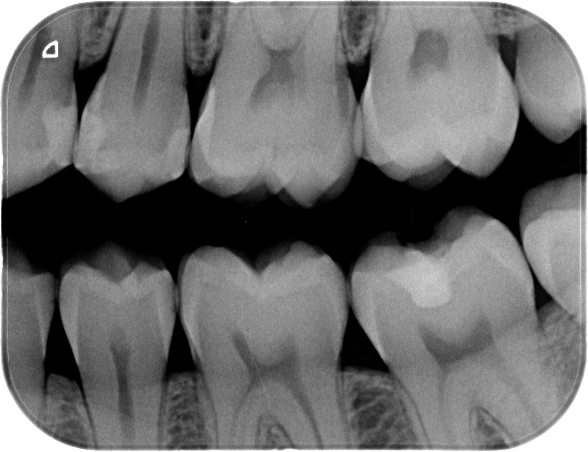 Dental X-ray showing molars and premolars with one tooth having a visible filling