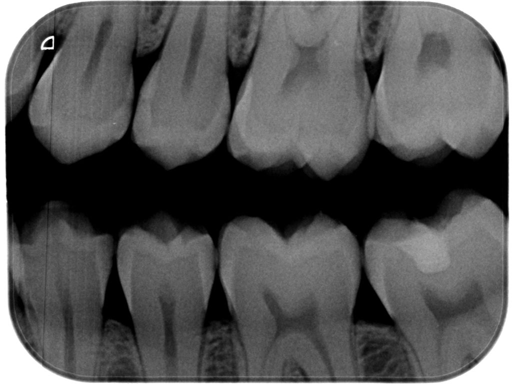 Dental X-ray showing multiple upper and lower teeth with visible roots and crowns