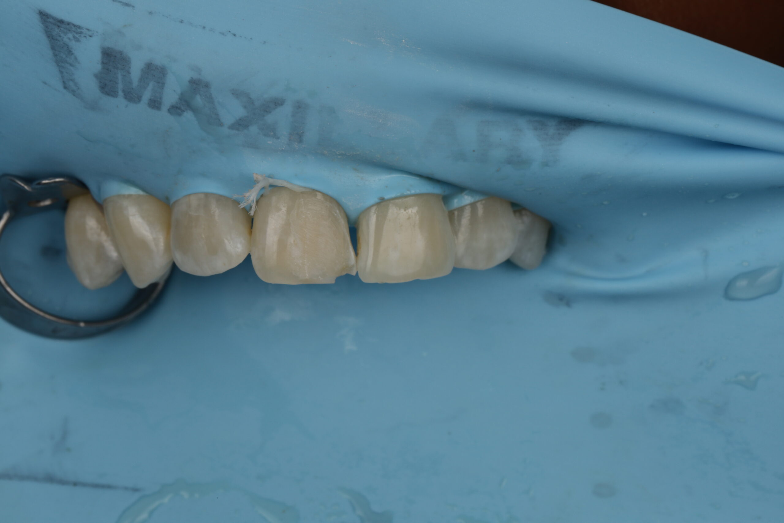 Close-up of several upper front teeth isolated with a blue dental rubber dam during a dental procedure.